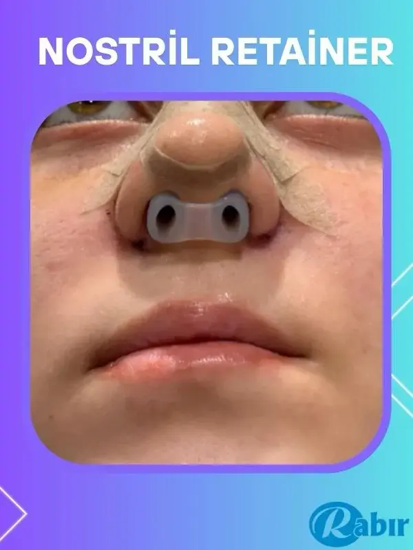 Rabır Nostril Retainer (Burun Deliği Şekillendirici) 9