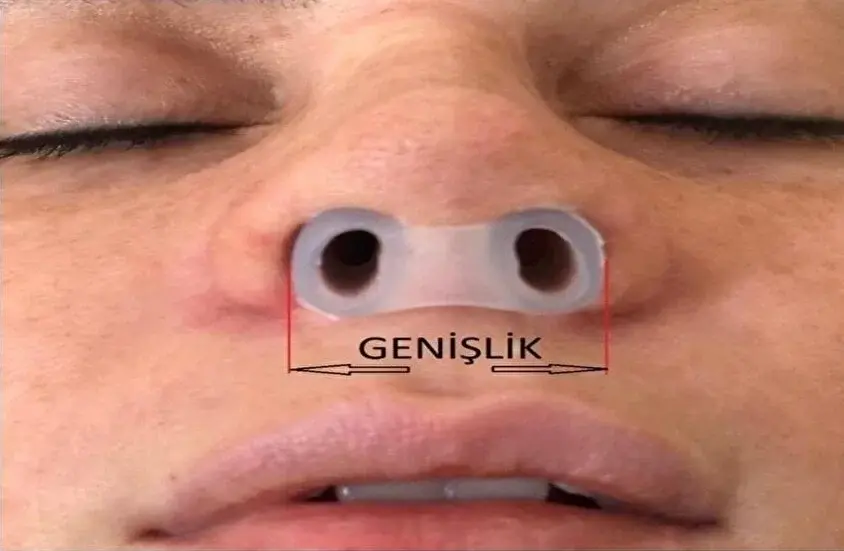 FixFlex Nostril Retainer (Burun Deliği Şekillendirici)